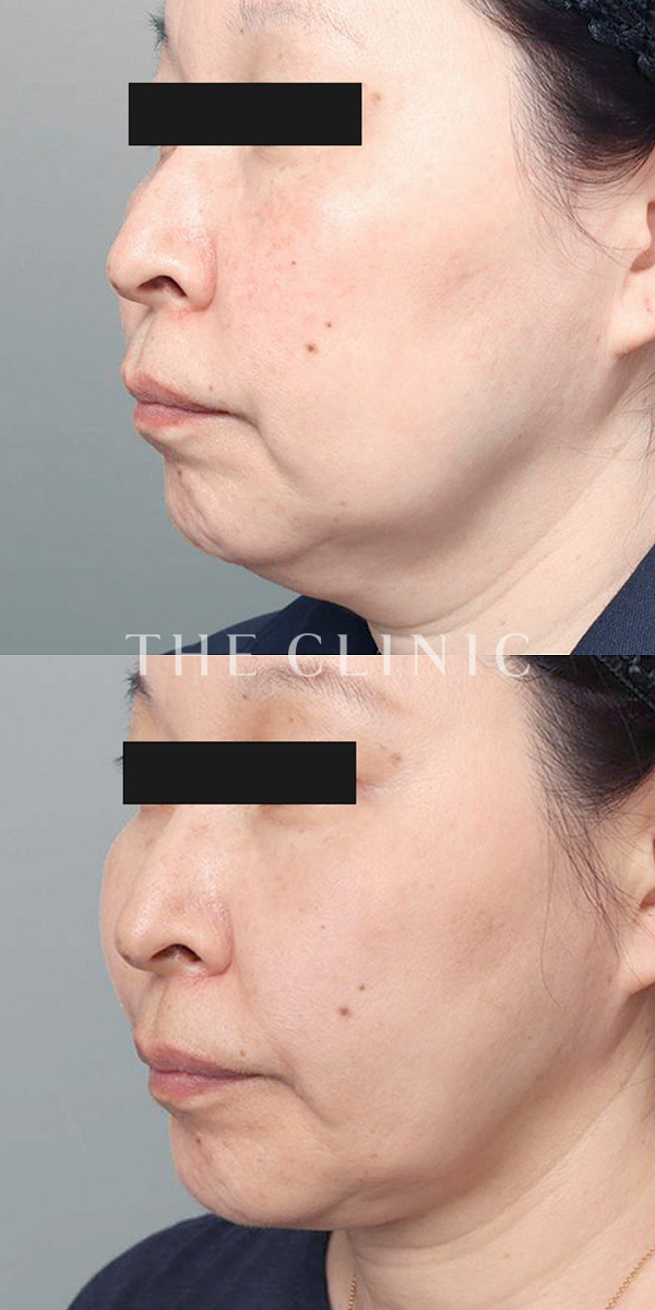 頰／顎のベイザー脂肪吸引（57歳女性）の術前・術後写真