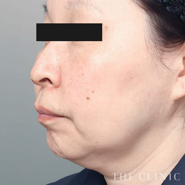 頰／顎のベイザー脂肪吸引（57歳女性）の術前写真