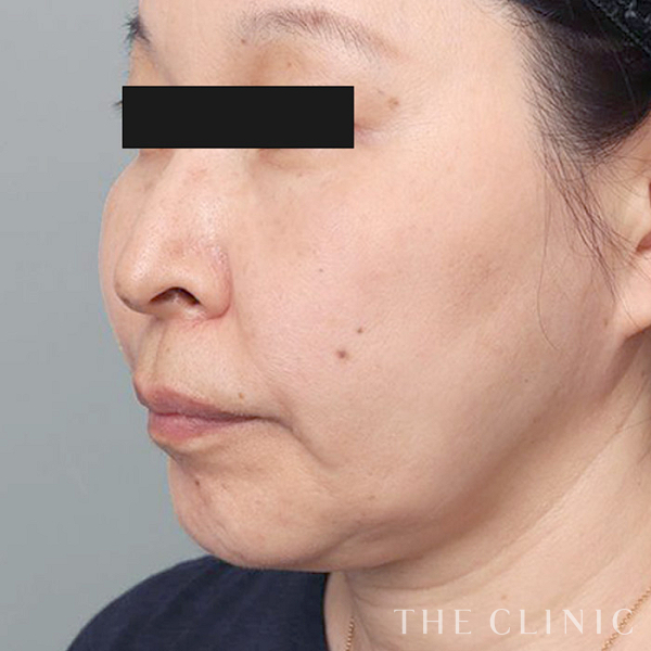 頰／顎のベイザー脂肪吸引（57歳女性）の術後写真