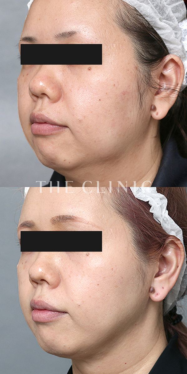 頰／顎のVOVリフト(ボブリフト・プレミアム)（39歳女性）の術前・術後写真