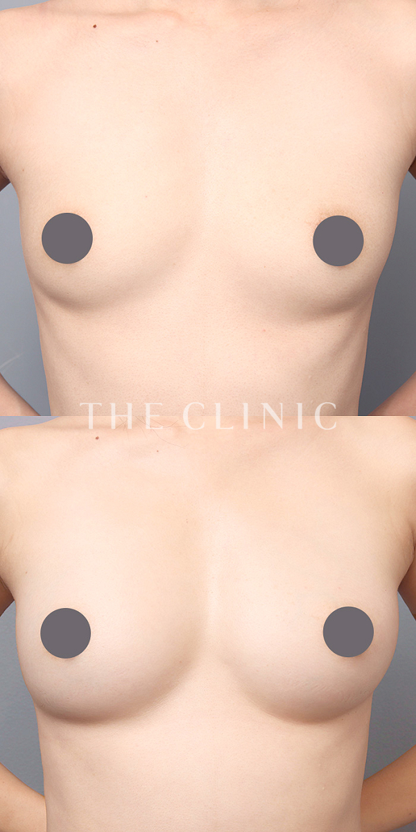 ボリュームアップのコンデンスリッチ豊胸（32歳女性）の術前・術後写真