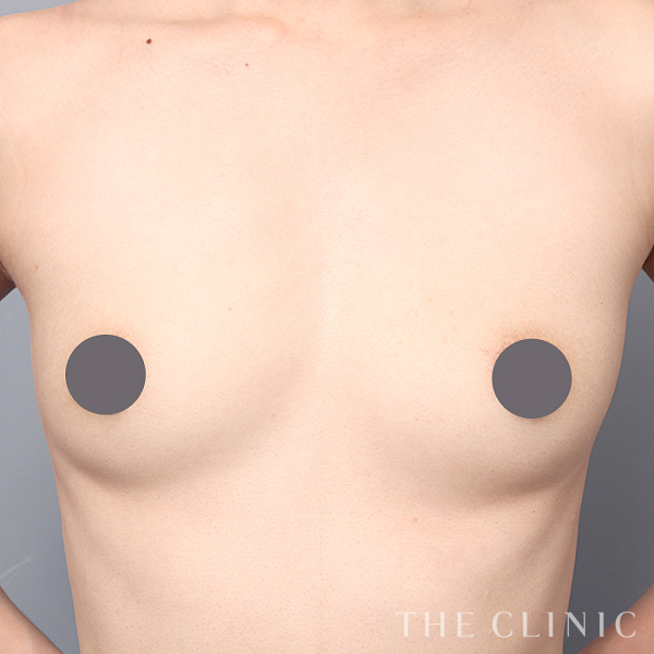 ボリュームアップのコンデンスリッチ豊胸（32歳女性）の術前写真