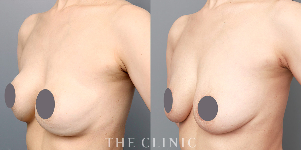 豊胸シリコンバッグ除去の術前／術後