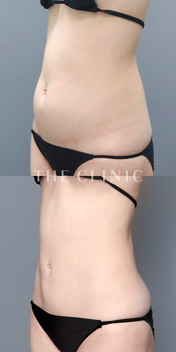 腰・ウエストのベイザー脂肪吸引（30歳女性）の術前・術後写真