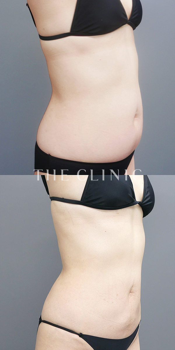 腰・ウエストのベイザー脂肪吸引（51歳女性）の術前・術後写真