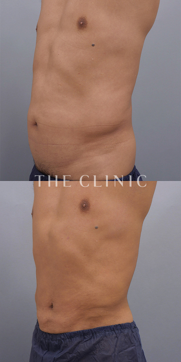腰・ウエストのベイザー脂肪吸引（57歳男性）の術前・術後写真