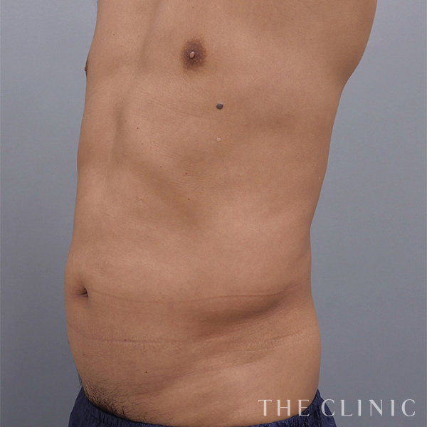 腰・ウエストのベイザー脂肪吸引（57歳男性）の術前写真