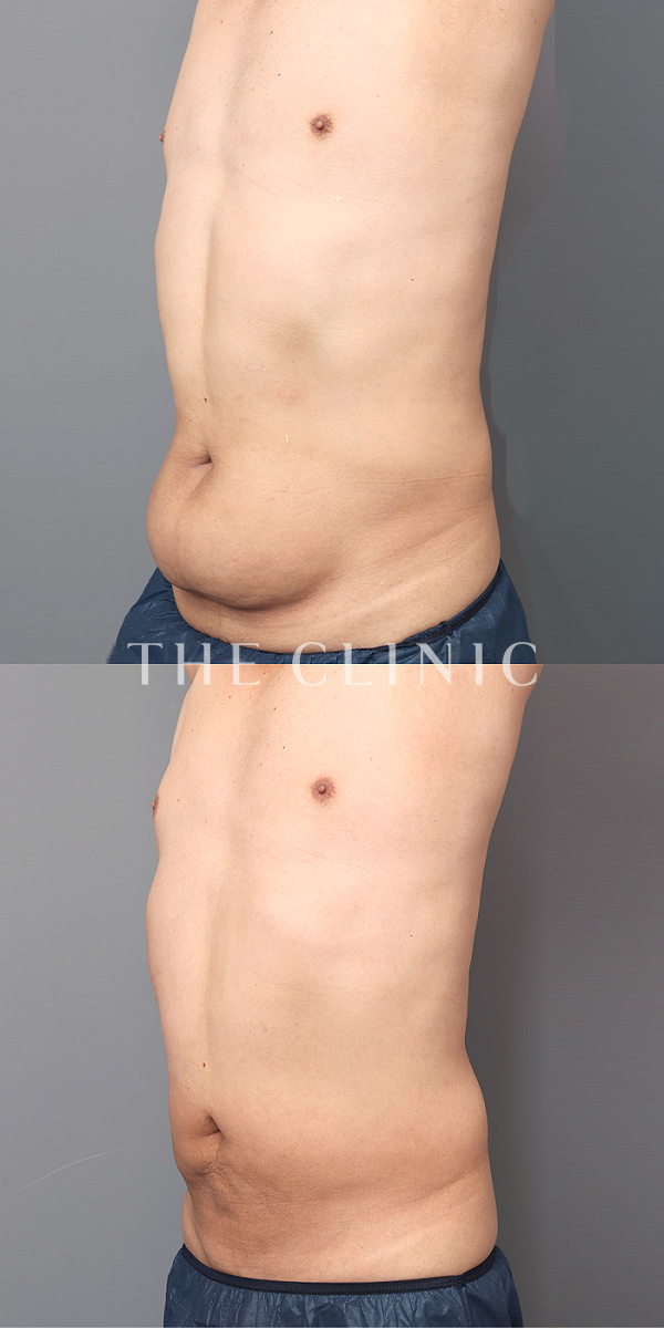 腹部のベイザー脂肪吸引（49歳男性）の術前・術後写真