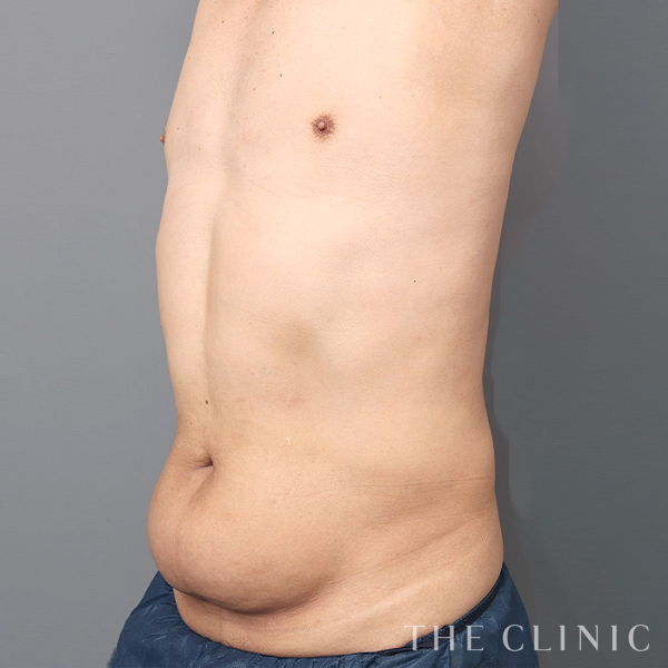 腹部のベイザー脂肪吸引（49歳男性）の術前写真