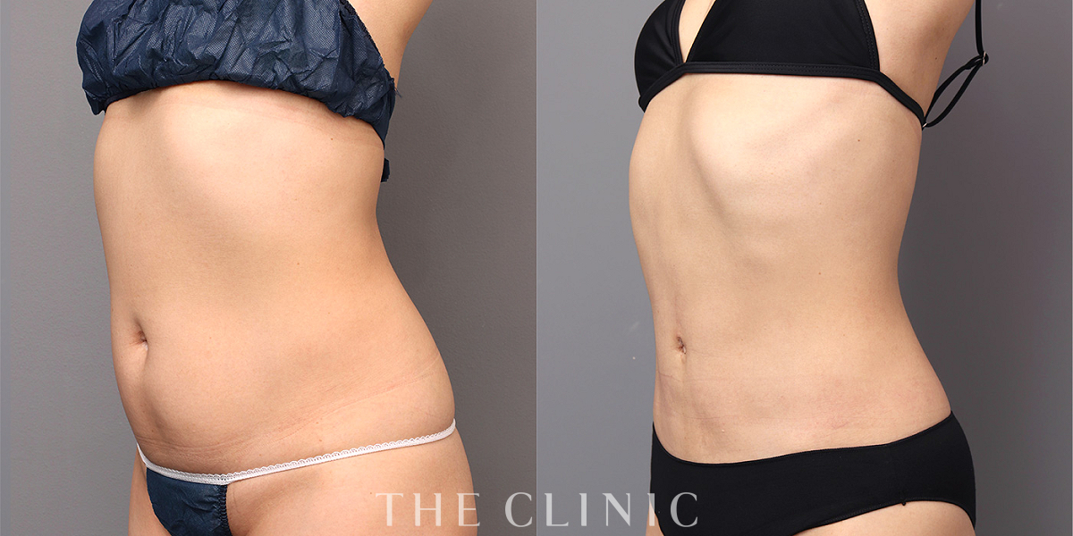 360°脂肪吸引の術前/術後