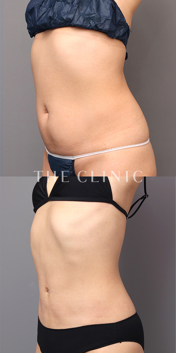 腹部の360°脂肪吸引（39歳女性）の術前・術後写真