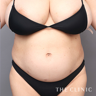 【THE CLINIC 症例画像】No.1513_1_腹部_360脂肪吸引®(執刀医:村田 八千穂)