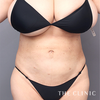 【THE CLINIC 症例画像】No.1513_2_腹部_360°脂肪吸引(執刀医:村田 八千穂)