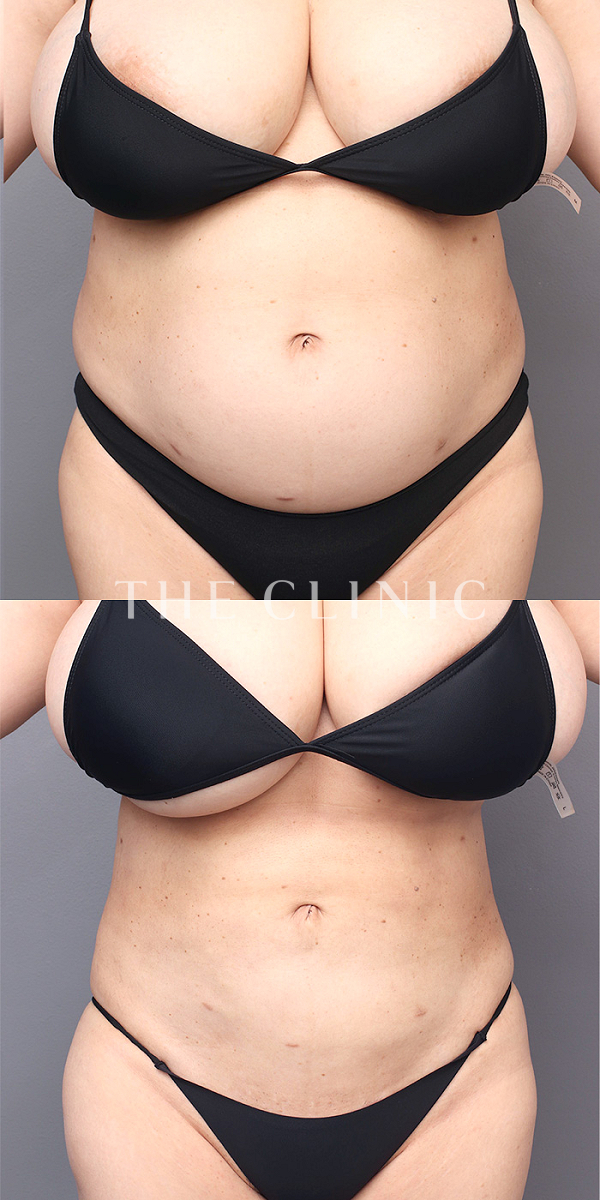 腹部の360°脂肪吸引（44歳女性）の術前・術後写真