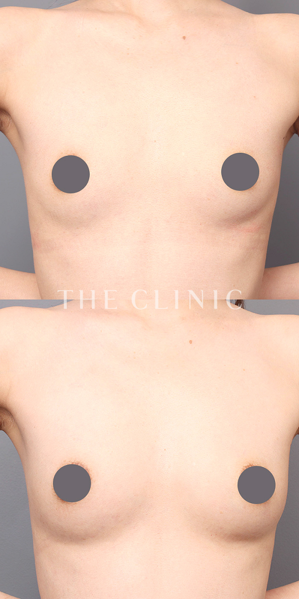 ボリュームアップの上向きバスト豊胸（38歳女性）の術前・術後写真