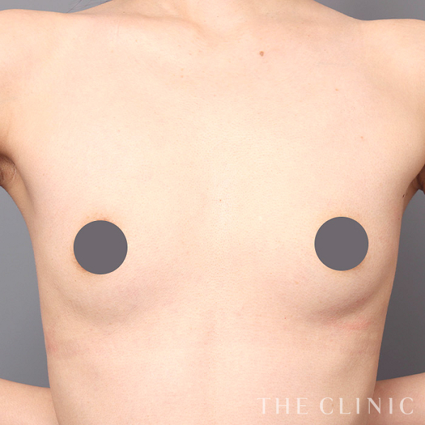 ボリュームアップの上向きバスト豊胸（38歳女性）の術前写真