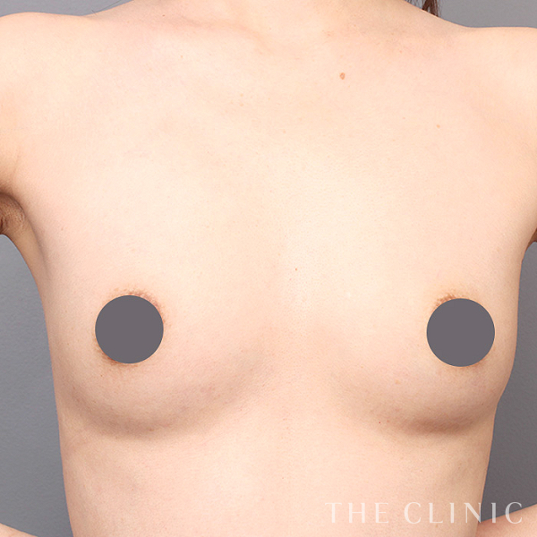 ボリュームアップの上向きバスト豊胸（38歳女性）の術後写真