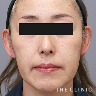 【THE CLINIC 症例画像】No.1515_1_目の上のくぼみ_コンデンスリッチフェイス(顔の脂肪注入)(執刀医：)