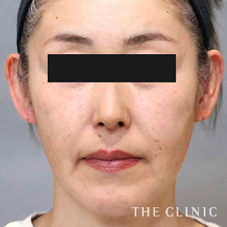 【THE CLINIC 症例画像】No.1515_2_目の上のくぼみ_コンデンスリッチフェイス(顔の脂肪注入)(執刀医:)