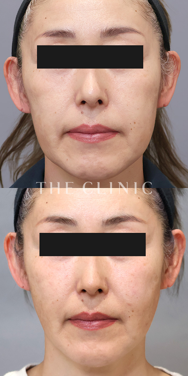 目の上のくぼみ・こけた頬のコンデンスリッチフェイス(顔の脂肪注入)（53歳女性）の術前・術後写真