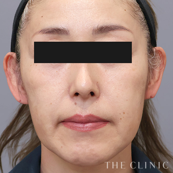 目の上のくぼみ・こけた頬のコンデンスリッチフェイス(顔の脂肪注入)（53歳女性）の術前写真