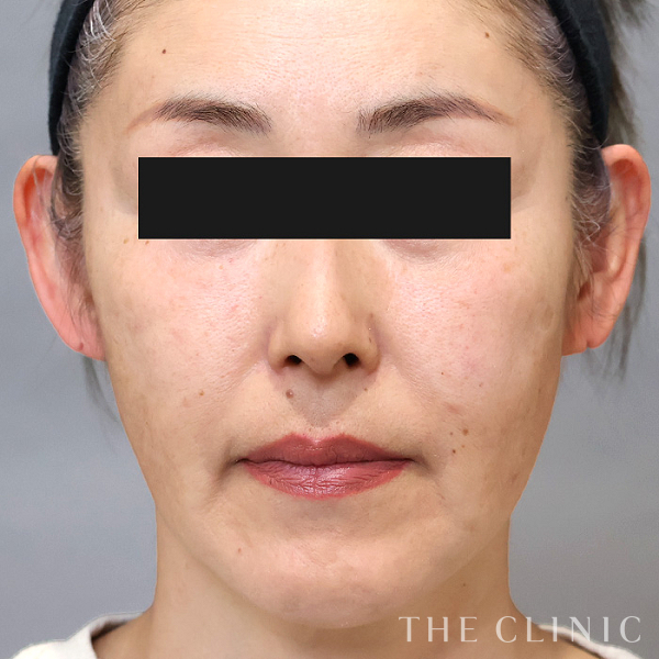 目の上のくぼみ・こけた頬のコンデンスリッチフェイス(顔の脂肪注入)（53歳女性）の術後写真