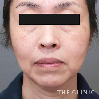 【THE CLINIC 症例画像】No.1516_1_目の下のクマ_コンデンスリッチフェイス(顔の脂肪注入)(執刀医:)
