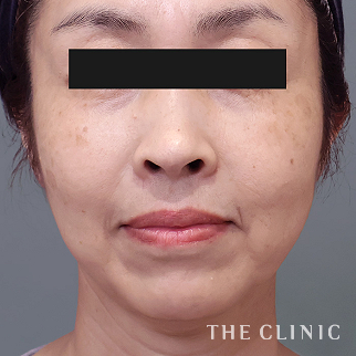 【THE CLINIC 症例画像】No.1516_2_目の下のクマ_コンデンスリッチフェイス(顔の脂肪注入)(執刀医:)