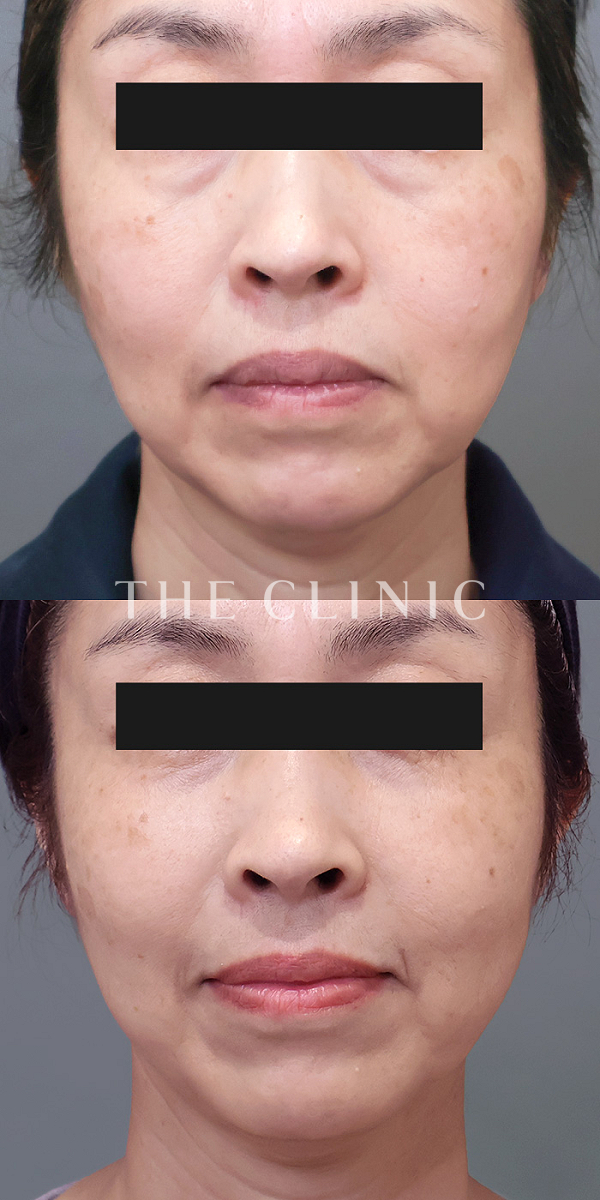 目の下のクマ・こけた頬・マリオネットラインのコンデンスリッチフェイス(顔の脂肪注入)（51歳女性）の術前・術後写真