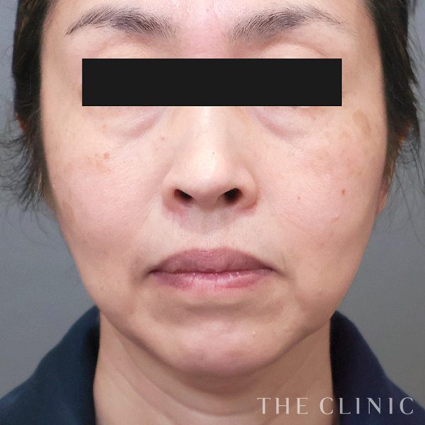 目の下のクマ・こけた頬・マリオネットラインのコンデンスリッチフェイス(顔の脂肪注入)（51歳女性）の術前写真