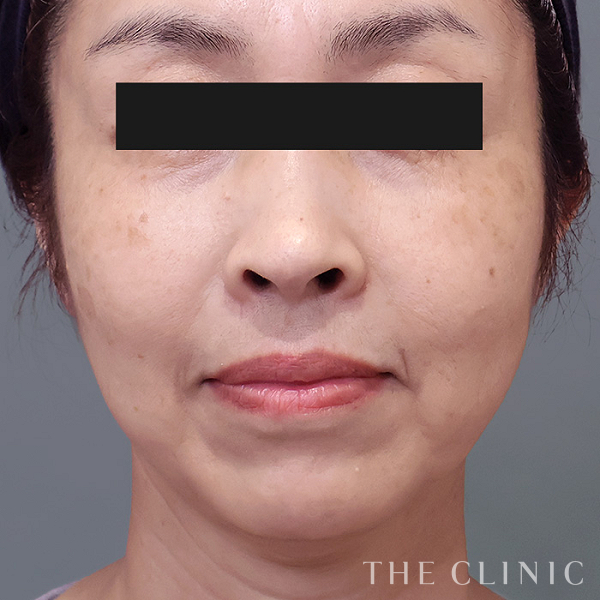 目の下のクマ・こけた頬・マリオネットラインのコンデンスリッチフェイス(顔の脂肪注入)（51歳女性）の術後写真