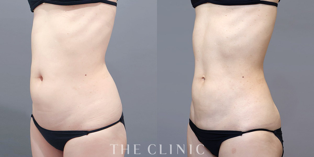 ベイザー脂肪吸引の術前/術後