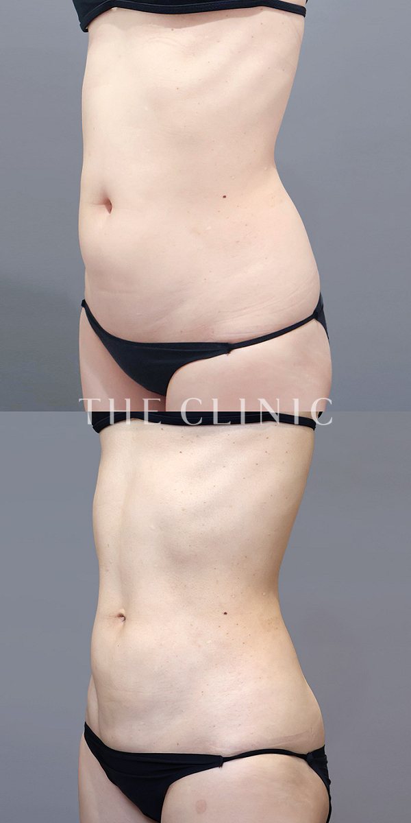 腰・ウエストのベイザー脂肪吸引（36歳女性）の術前・術後写真