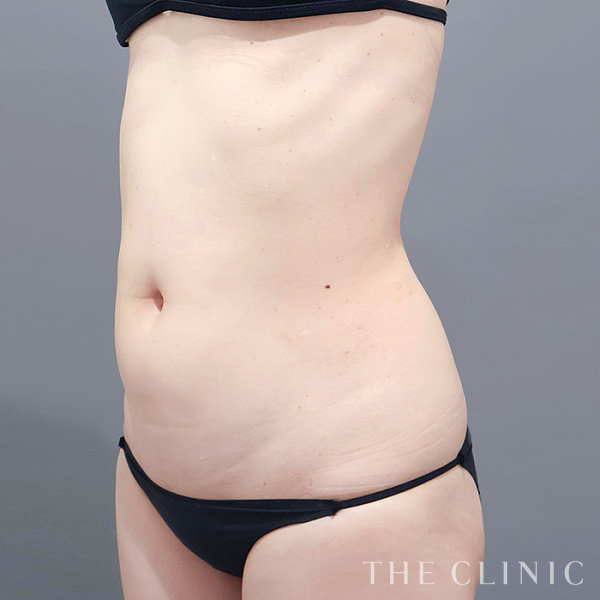 腰・ウエストのベイザー脂肪吸引（36歳女性）の術前写真