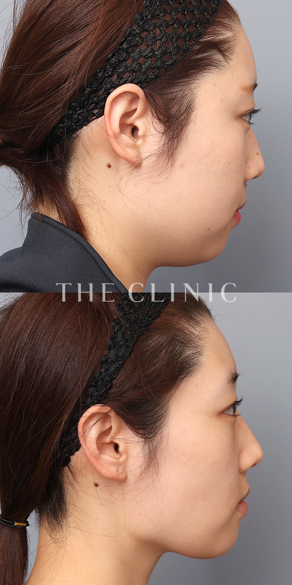 頰／顎のベイザー脂肪吸引（28歳女性）の術前・術後写真