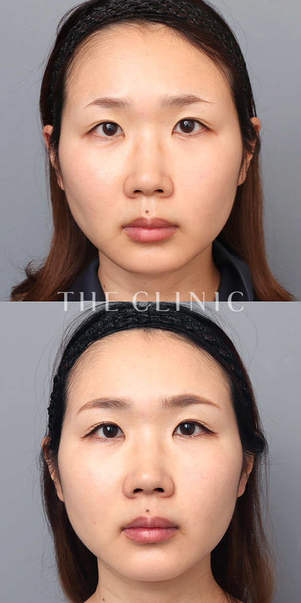 こけた頬のマイクロCRF注入(顔の脂肪注入)（36歳女性）の術前・術後写真