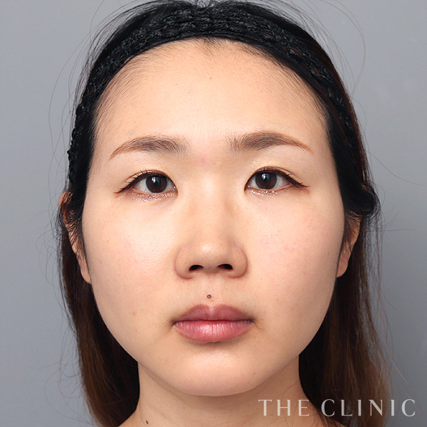 こけた頬のマイクロCRF注入(顔の脂肪注入)（36歳女性）の術後写真