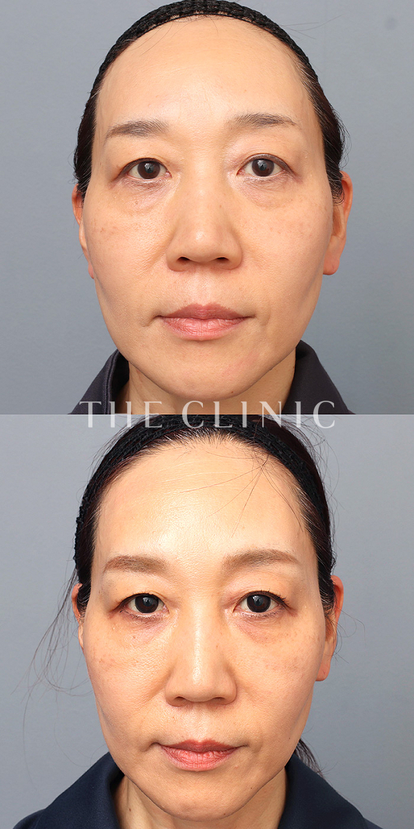 目の下のたるみのモフィウス8（50歳女性）の術前・術後写真