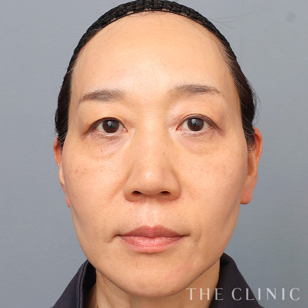 目の下のたるみのモフィウス8（50歳女性）の術前写真