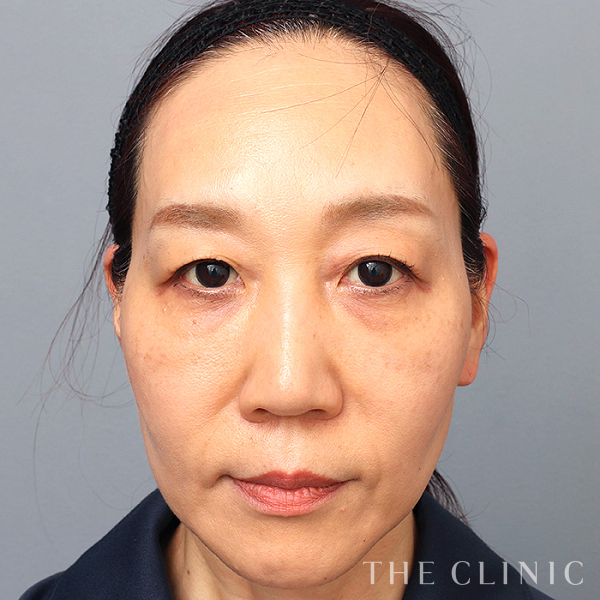 目の下のたるみのモフィウス8（50歳女性）の術後写真