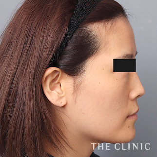 【THE CLINIC 症例画像】No.1523_1_おでこ(額)のくぼみ_コンデンスリッチフェイス(顔の脂肪注入)(執刀医：帯包 雄次郎)