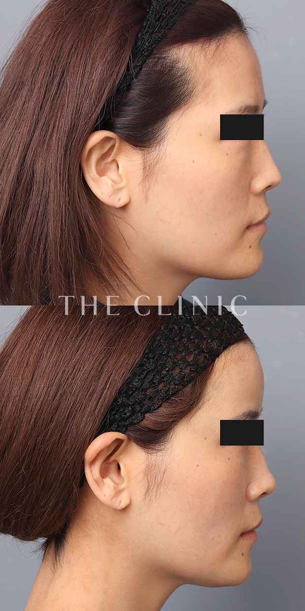 おでこ(額)のくぼみのコンデンスリッチフェイス(顔の脂肪注入)（37歳女性）の術前・術後写真