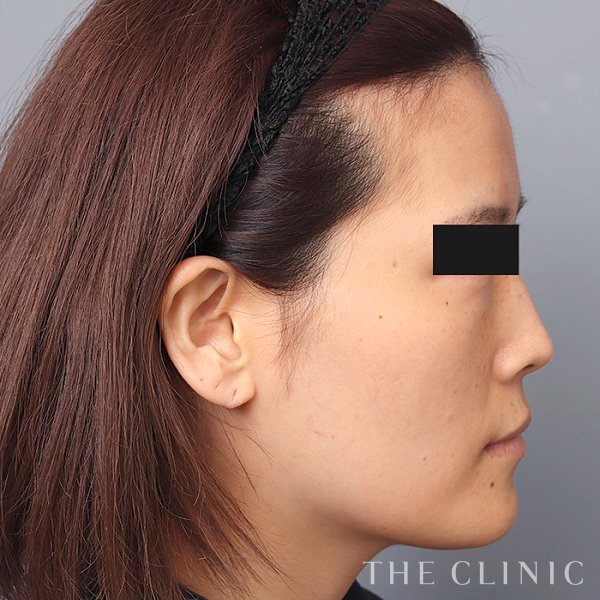 おでこ(額)のくぼみのコンデンスリッチフェイス(顔の脂肪注入)（37歳女性）の術前写真