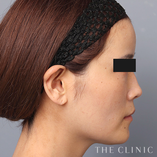 おでこ(額)のくぼみのコンデンスリッチフェイス(顔の脂肪注入)（37歳女性）の術後写真