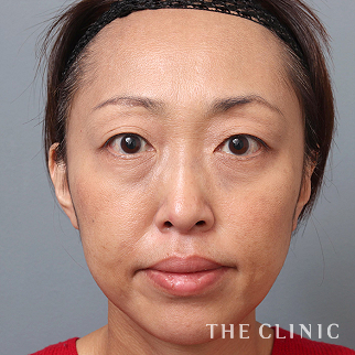 【THE CLINIC 症例画像】No.1524_2_目の下のたるみ_モフィウス8/モフィウス8バースト(執刀医:村田 八千穂)