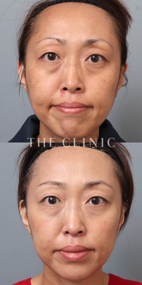 目の下のたるみのモフィウス8（46歳女性）の術前・術後写真