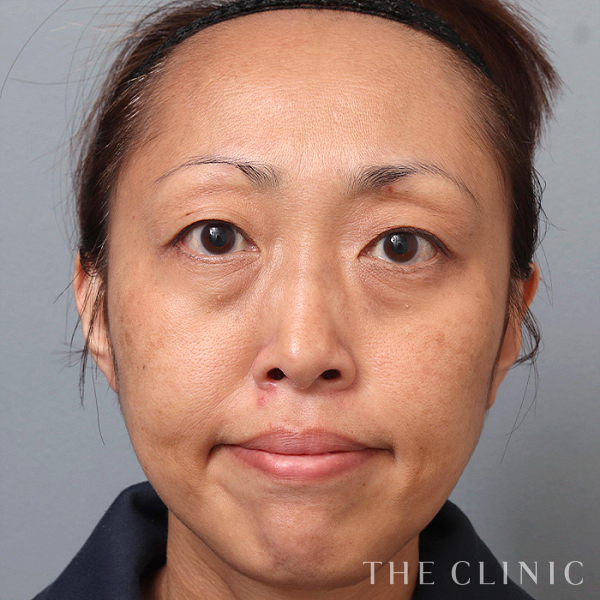 目の下のたるみのモフィウス8（46歳女性）の術前写真