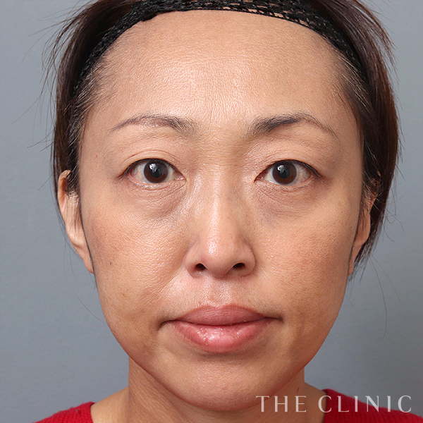 目の下のたるみのモフィウス8（46歳女性）の術後写真