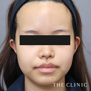 【THE CLINIC 症例画像】No.1525_1_頰/顎_360脂肪吸引®