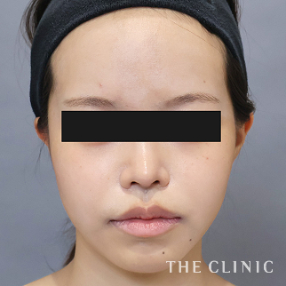 【THE CLINIC 症例画像】No.1525_2_頰/顎_ベイザー脂肪吸引